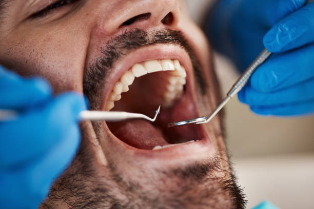 Best Emergency Wisdom Teeth Removal in Huber Heights, OH