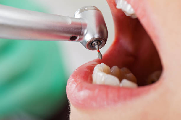Best Emergency Treatment for Dental Infections or Abscesses in Huber Heights, OH